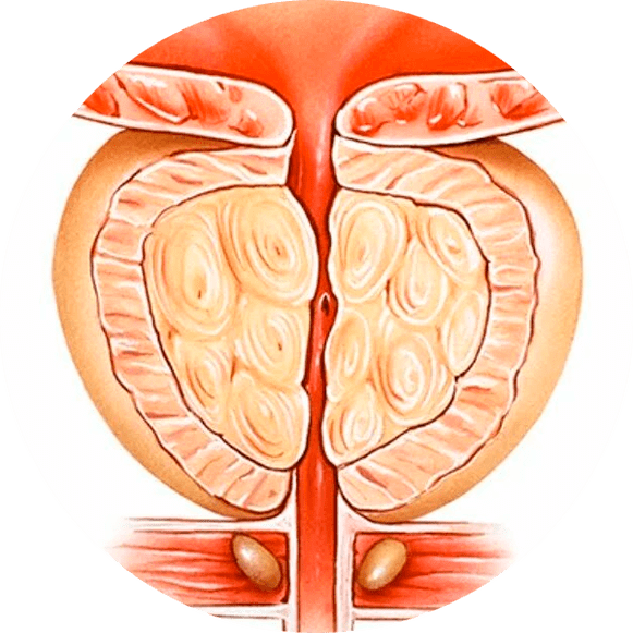 Conséquences d'une prostatite non traitée