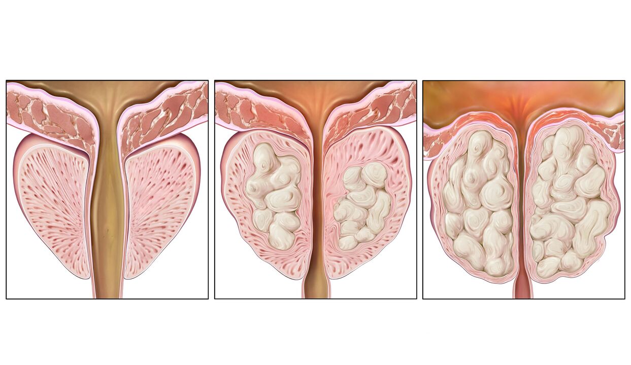 stades du cancer de la prostate