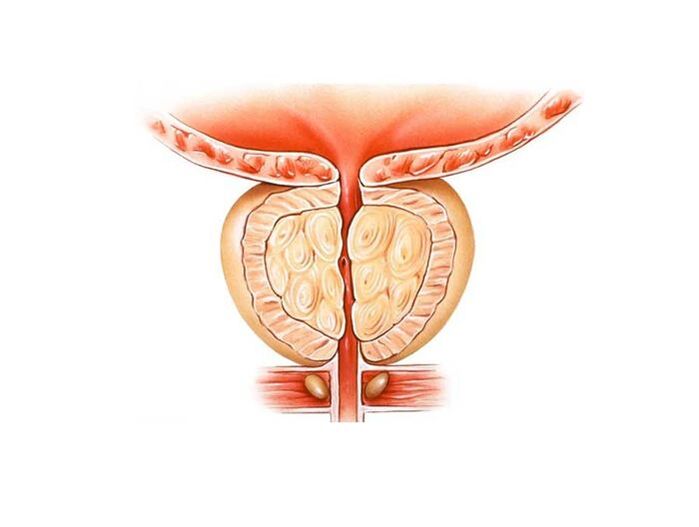 traitement de la prostatite avec des remèdes maison